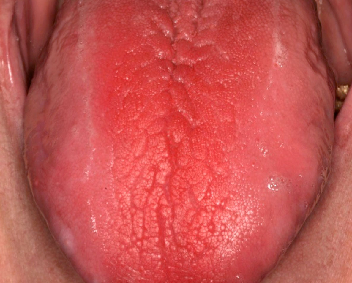strawberry tongue