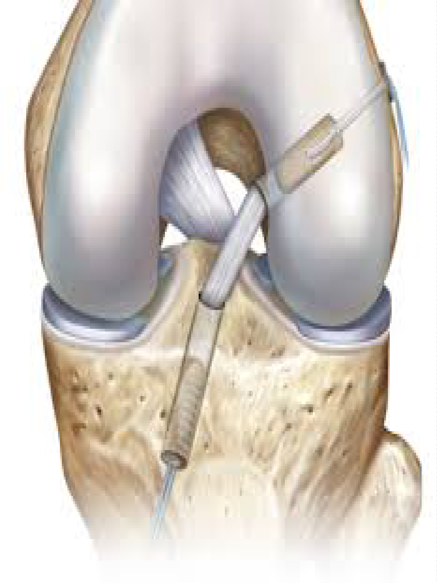 Graft Tunnel Mismatch In Anterior Cruciate Ligament Reconstruction With
