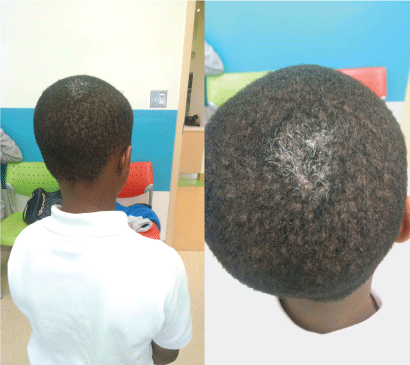 What's Your Diagnosis? A 7-Year-Old Boy with a White Hair Patch on the Head  for Three Months